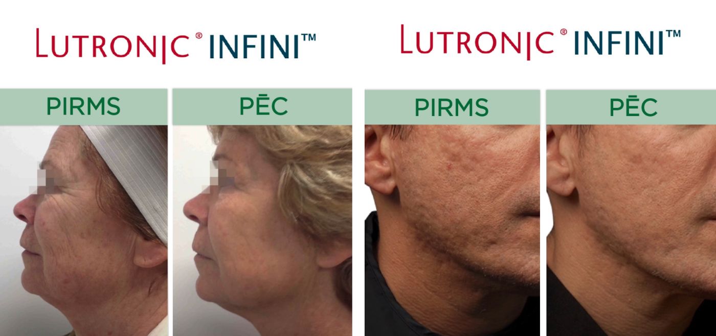 Lutronic Infini procedūra